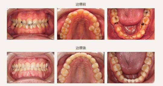 受け口・下顎前突の矯正歯科治療例 仙台の歯科