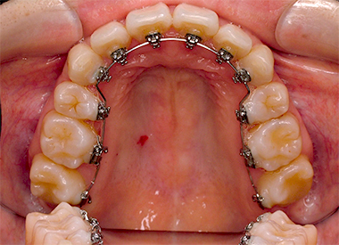 舌側矯正 仙台で装置が見えづらい舌側矯正は当院へご相談下さい