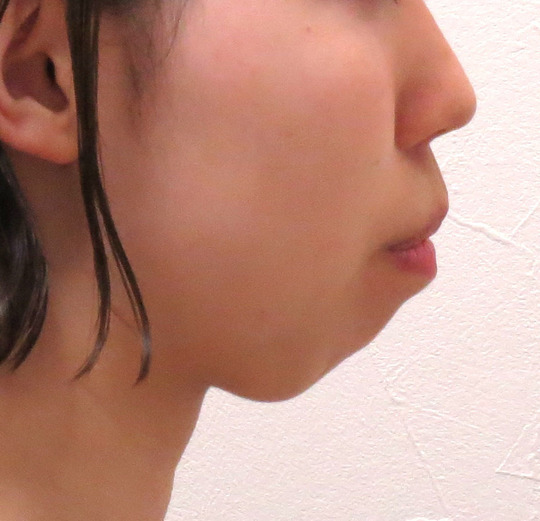 口ゴボ矯正治療