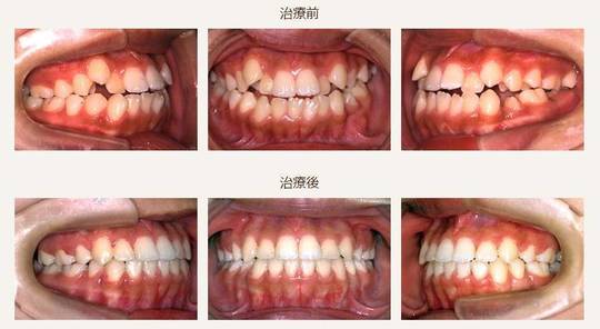 叢生 八重歯 乱杭歯の矯正歯科治療例 仙台の歯科